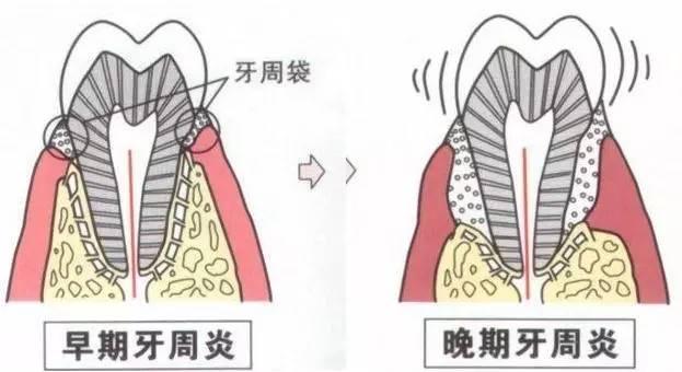 牙周病是什么 牙周病分类及预防